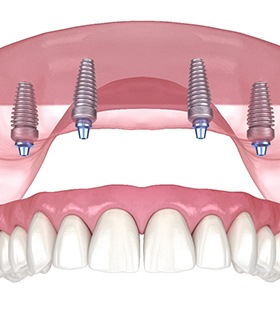 Man discussing All-On-4 implants with dentist