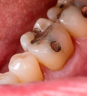 An up-close view of a patient’s back molars that contain traditional amalgam