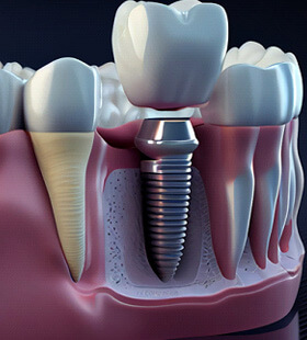 A digital mold of a titanium dental implant
