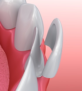 Animation of porcelain veneer placement