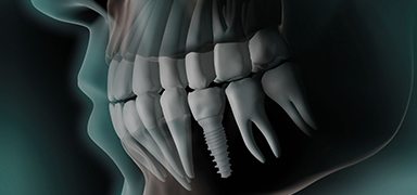 Animation of smile with implant supported dental crown