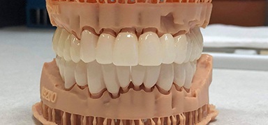 Model of implant supported denture