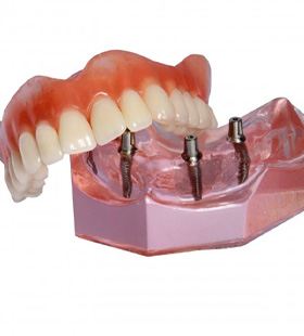 Implant dentures in Delafield  