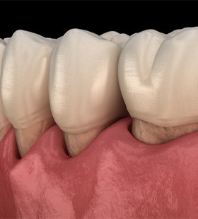 Digital image of receding gums  