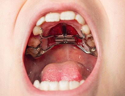 Up close view of a child’s palate/jaw expander