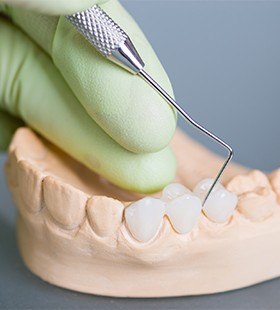 Model smile with fixed bridge restoration