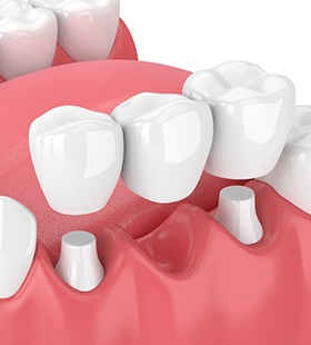 Animation of dental implant placement