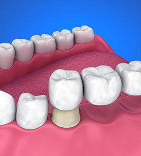 Digital image of a fixed bridge placed on the lower arch of the mouth