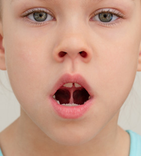 Young girl with a tongue-tie 