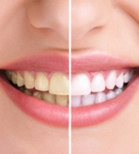 Before and after image of teeth whitening in Delafield 