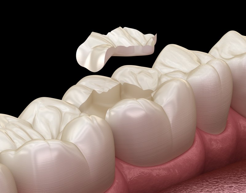 A dental inlay
